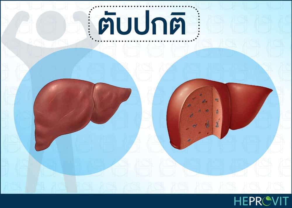 HEPROVIT เฮโปรวิท ฟื้นฟูตับ บำรุงตับ รักษาตับ ดีท็อกซ์ตับ ล้างสารพิษตับ ไขมันพอกตับ ตับอักเสบ ตับแข็ง ไวรัสตับอักเสบเอ ไวรัสตับอักเสบบี ไวรัสตับอักเสบซี มะเร็งตับ ตาเหลืองตัวเหลือง เจ็บชายโครงด้านขวา ง่วงกลางวัน ตื่นกลางคืน ดื่มแล้วเป็นผื่นแดง คันตามตัวไม่มีสาเหตุ มือเท้าบวม ท้องมาน ปวดตามข้อ ท้องอืด แน่น หายใจไม่สะดวก ดื่มเหล้า สุรา อ้วน ไขมัน