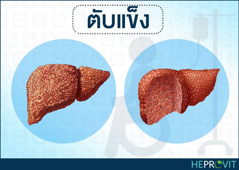 HEPROVIT เฮโปรวิท ฟื้นฟูตับ บำรุงตับ รักษาตับ ดีท็อกซ์ตับ ล้างสารพิษตับ ไขมันพอกตับ ตับอักเสบ ตับแข็ง ไวรัสตับอักเสบเอ ไวรัสตับอักเสบบี ไวรัสตับอักเสบซี มะเร็งตับ ตาเหลืองตัวเหลือง เจ็บชายโครงด้านขวา ง่วงกลางวัน ตื่นกลางคืน ดื่มแล้วเป็นผื่นแดง คันตามตัวไม่มีสาเหตุ มือเท้าบวม ท้องมาน ปวดตามข้อ ท้องอืด แน่น หายใจไม่สะดวก ดื่มเหล้า สุรา อ้วน ไขมัน