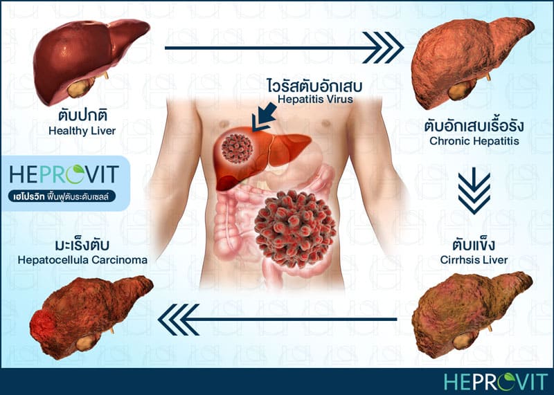 HEPROVIT เฮโปรวิท ฟื้นฟูตับไบำรุงตับ รักษาตับ ดีท็อกซ์ตับ ล้างสารพิษตับ ไขมันพอกตับ ตับอักเสบ ตับแข็ง ไวรัสตับอักเสบเอ ไวรัสตับอักเสบบี ไวรัสตับอักเสบซี มะเร็งตับ ตาเหลืองตัวเหลือง เจ็บชายโครงด้านขวา ง่วงกลางวัน ตื่นกลางคืน ดื่มแล้วเป็นผื่นแดง คันตามตัวไม่มีสาเหตุ มือเท้าบวม ท้องมาน ปวดตามข้อ ท้องอืด แน่น หายใจไม่สะดวก ดื่มเหล้า สุรา อ้วน ไขมัน