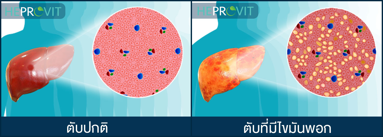 HEPROVIT เฮโปรวิท ฟื้นฟูตับไบำรุงตับ รักษาตับ ดีท็อกซ์ตับ ล้างสารพิษตับ ไขมันพอกตับ ตับอักเสบ ตับแข็ง ไวรัสตับอักเสบเอ ไวรัสตับอักเสบบี ไวรัสตับอักเสบซี มะเร็งตับ ตาเหลืองตัวเหลือง เจ็บชายโครงด้านขวา ง่วงกลางวัน ตื่นกลางคืน ดื่มแล้วเป็นผื่นแดง คันตามตัวไม่มีสาเหตุ มือเท้าบวม ท้องมาน ปวดตามข้อ ท้องอืด แน่น หายใจไม่สะดวก ดื่มเหล้า สุรา อ้วน ไขมัน