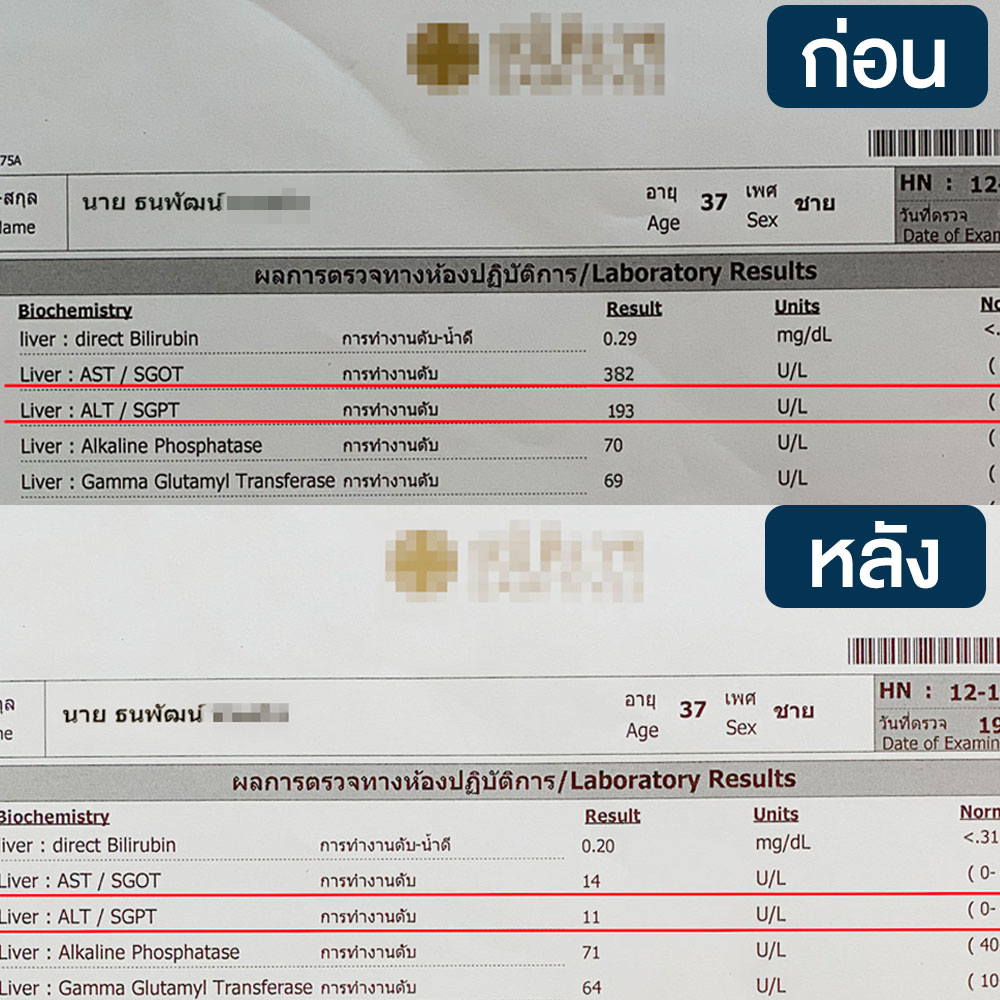 HEPROVIT เฮโปรวิท ฟื้นฟูตับไบำรุงตับ รักษาตับ ดีท็อกซ์ตับ ล้างสารพิษตับ ไขมันพอกตับ ตับอักเสบ ตับแข็ง ไวรัสตับอักเสบเอ ไวรัสตับอักเสบบี ไวรัสตับอักเสบซี มะเร็งตับ ตาเหลืองตัวเหลือง เจ็บชายโครงด้านขวา ง่วงกลางวัน ตื่นกลางคืน ดื่มแล้วเป็นผื่นแดง คันตามตัวไม่มีสาเหตุ มือเท้าบวม ท้องมาน ปวดตามข้อ ท้องอืด แน่น หายใจไม่สะดวก ดื่มเหล้า สุรา อ้วน ไขมัน