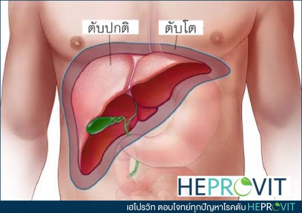 HEPROVIT เฮโปรวิท ฟื้นฟูตับ บำรุงตับ รักษาตับ ดีท็อกซ์ตับ ล้างสารพิษตับ ไขมันพอกตับ ตับอักเสบ ตับแข็ง ไวรัสตับอักเสบเอ ไวรัสตับอักเสบบี ไวรัสตับอักเสบซี มะเร็งตับ ตาเหลืองตัวเหลือง เจ็บชายโครงด้านขวา ง่วงกลางวัน ตื่นกลางคืน ดื่มแล้วเป็นผื่นแดง คันตามตัวไม่มีสาเหตุ มือเท้าบวม ท้องมาน ปวดตามข้อ ท้องอืด แน่น หายใจไม่สะดวก ดื่มเหล้า สุรา อ้วน ไขมัน