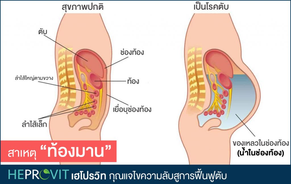 HEPROVIT เฮโปรวิท ฟื้นฟูตับ บำรุงตับ รักษาตับ ดีท็อกซ์ตับ ล้างสารพิษตับ ไขมันพอกตับ ตับอักเสบ ตับแข็ง ไวรัสตับอักเสบเอ ไวรัสตับอักเสบบี ไวรัสตับอักเสบซี มะเร็งตับ ตาเหลืองตัวเหลือง เจ็บชายโครงด้านขวา ง่วงกลางวัน ตื่นกลางคืน ดื่มแล้วเป็นผื่นแดง คันตามตัวไม่มีสาเหตุ มือเท้าบวม ท้องมาน ปวดตามข้อ ท้องอืด แน่น หายใจไม่สะดวก ดื่มเหล้า สุรา อ้วน ไขมัน